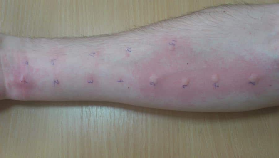 teslić alergotestiranje